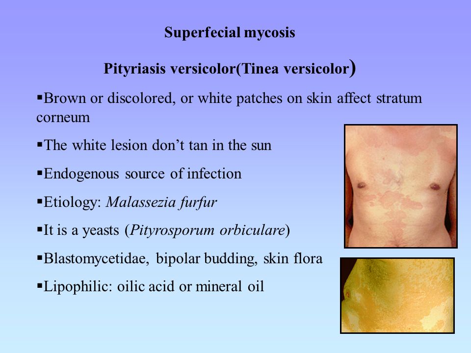 Pityriasis versicolor(Tinea versicolor) - ppt video online download