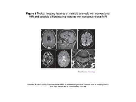 MRI and possible differentiating features with nonconventional MRI
