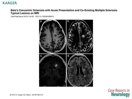Balo's Concentric Sclerosis with Acute Presentation and Co-Existing Multiple Sclerosis-Typical Lesions on MRI Case Rep Neurol 2015;7:44-50 - DOI:10.1159/000380813.