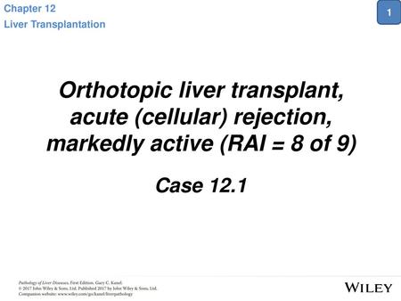 Chapter 12 Liver Transplantation 1