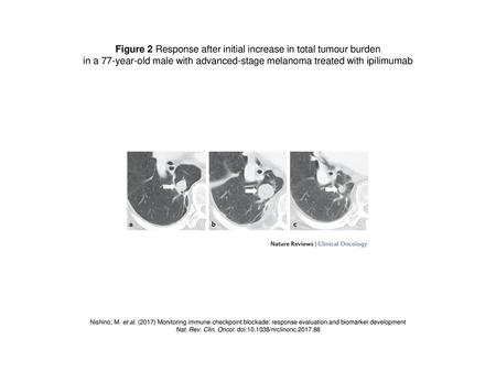 Figure 2 Response after initial increase in total tumour burden