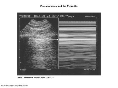 Pneumothorax and the A′-profile.