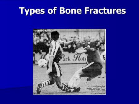 Types of Bone Fractures. Stress – Strain Force (N) Deformation (cm)