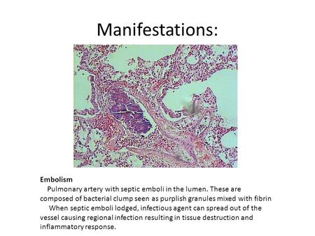 Manifestations: Embolism Pulmonary artery with septic emboli in the lumen. These are composed of bacterial clump seen as purplish granules mixed with fibrin.