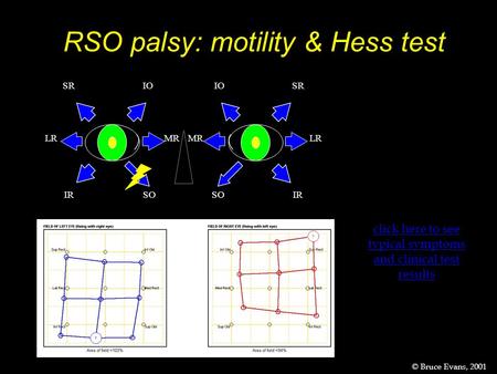 RSO palsy: motility & Hess test