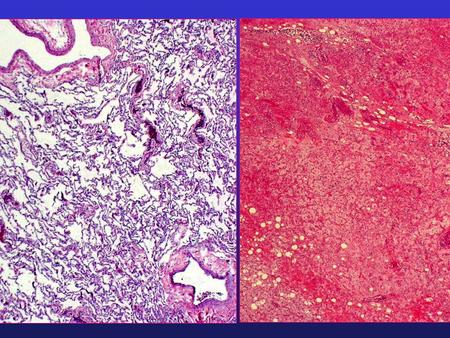 Final Diagnosis: Lung Mass, Right (wedge excision): - Metastatic myxoid Liposarcoma, grade 2 of 4. Note: This tumor has an appearance similar.