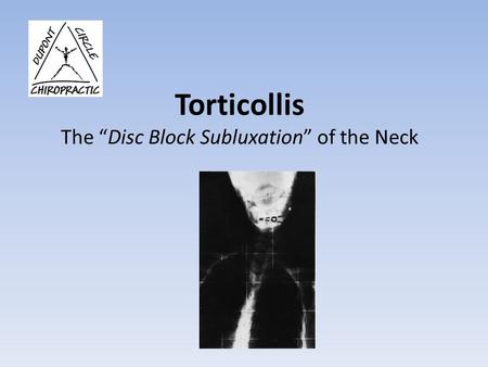 Torticollis The “Disc Block Subluxation” of the Neck