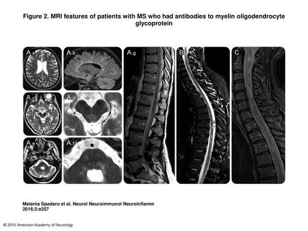 Figure 2. MRI features of patients with MS who had antibodies to myelin oligodendrocyte glycoprotein MRI features of patients with MS who had antibodies.