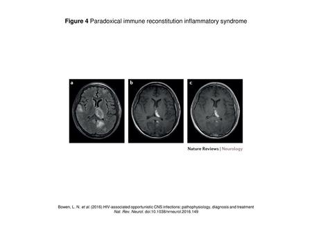 Figure 4 Paradoxical immune reconstitution inflammatory syndrome