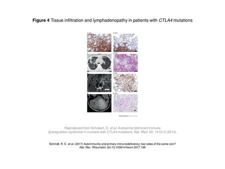 Figure 4 Tissue infiltration and lymphadenopathy in patients with CTLA4 mutations Figure 4 | Tissue infiltration and lymphadenopathy in patients with CTLA4.
