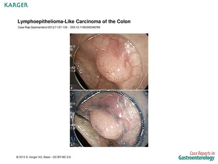 Lymphoepithelioma-Like Carcinoma of the Colon