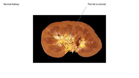 Normal kidney This fat is normal.