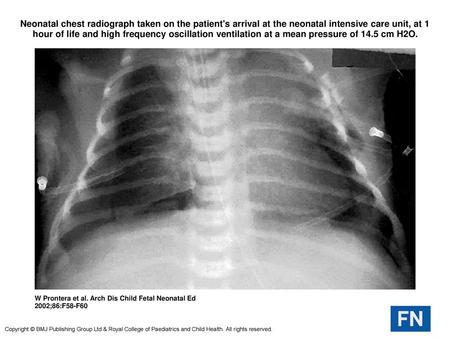 Neonatal chest radiograph taken on the patient's arrival at the neonatal intensive care unit, at 1 hour of life and high frequency oscillation ventilation.