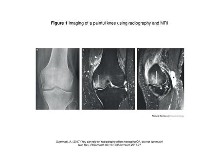 Figure 1 Imaging of a painful knee using radiography and MRI