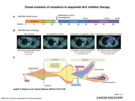 Clonal evolution of resistance to sequential ALK inhibitor therapy.