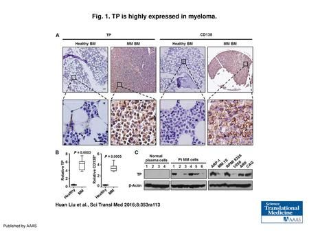 Fig. 1. TP is highly expressed in myeloma.