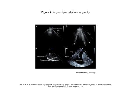Figure 1 Lung and pleural ultrasonography