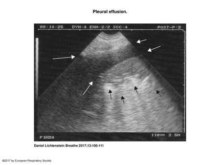 Pleural effusion. Pleural effusion. Longitudinal scan at the PLAPS point. The pleural effusion is defined not because of (as shown here) a hypoechoic tone.