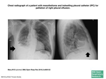 Chest radiograph of a patient with mesothelioma and indwelling pleural catheter (IPC) for palliation of right pleural effusion. Chest radiograph of a patient.