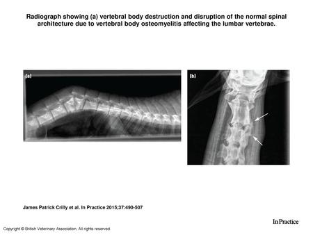 Radiograph showing (a) vertebral body destruction and disruption of the normal spinal architecture due to vertebral body osteomyelitis affecting the lumbar.