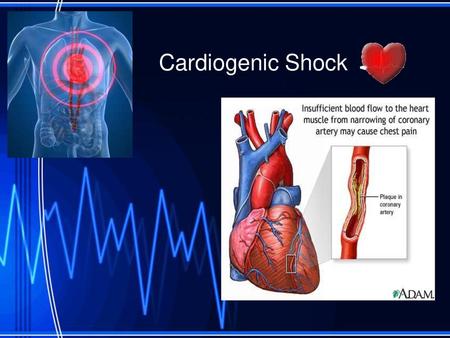Cardiogenic Shock.