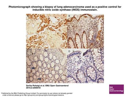 Photomicrograph showing a biopsy of lung adenocarcinoma used as a positive control for inducible nitric oxide synthase (iNOS) immunostain. Photomicrograph.