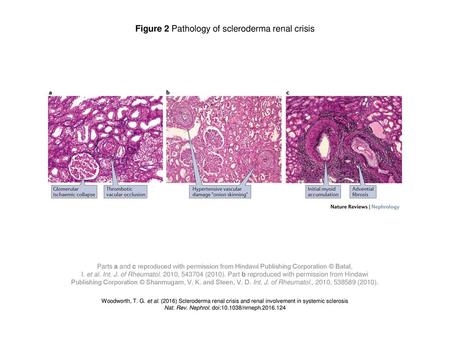Figure 2 Pathology of scleroderma renal crisis