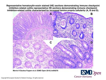 Representative hematoxylin-eosin stained (HE) sections demonstrating immune checkpoint inhibition-related colitis representative HE sections demonstrating.