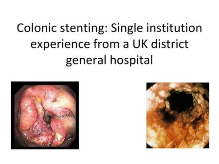 Background 8-29 % of patients with colon cancer present with partial or total obstruction (1) Emergency surgery is associated with up to 25% mortality.