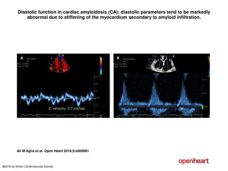 Diastolic function in cardiac amyloidosis (CA): diastolic parameters tend to be markedly abnormal due to stiffening of the myocardium secondary to amyloid.