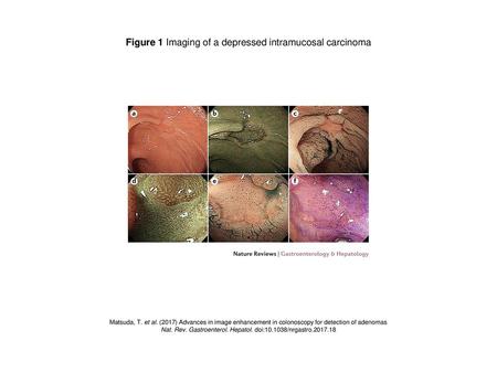 Figure 1 Imaging of a depressed intramucosal carcinoma