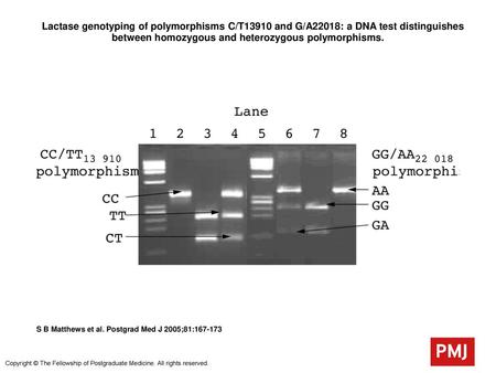  Lactase genotyping of polymorphisms C/T13910 and G/A22018: a DNA test distinguishes between homozygous and heterozygous polymorphisms.  Lactase genotyping.