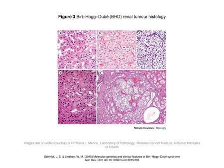 Figure 3 Birt–Hogg–Dubé (BHD) renal tumour histology
