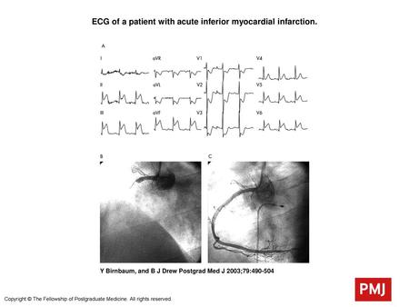 ECG of a patient with acute inferior myocardial infarction.