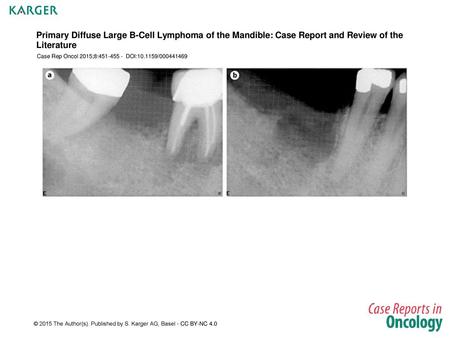 Primary Diffuse Large B-Cell Lymphoma of the Mandible: Case Report and Review of the Literature Case Rep Oncol 2015;8:451-455 - DOI:10.1159/000441469.