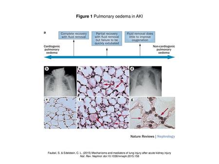 Figure 1 Pulmonary oedema in AKI