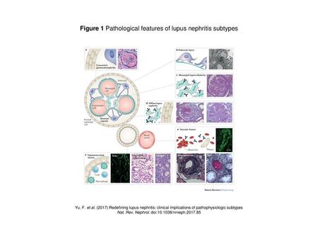 Figure 1 Pathological features of lupus nephritis subtypes