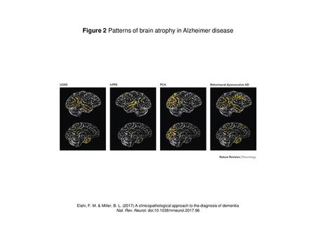 Figure 2 Patterns of brain atrophy in Alzheimer disease