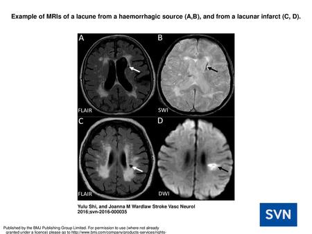 Example of MRIs of a lacune from a haemorrhagic source (A,B), and from a lacunar infarct (C, D). Example of MRIs of a lacune from a haemorrhagic source.