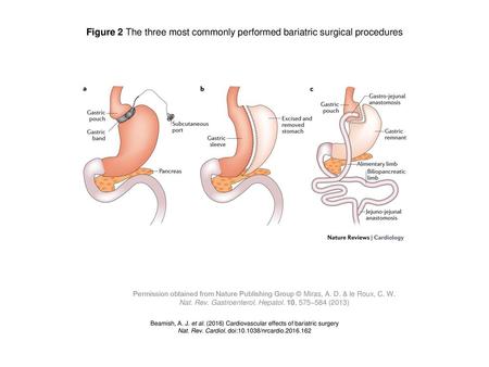 Figure 2 The three most commonly performed bariatric surgical procedures Figure 2 | The three most commonly performed bariatric surgical procedures. a.