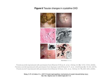 Figure 6 Tissular changes in crystalline CKD