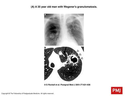 (A) A 35 year old man with Wegener's granulomatosis.