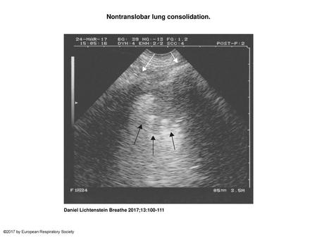 Nontranslobar lung consolidation.