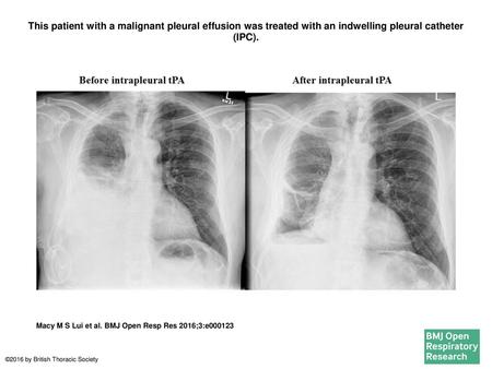 This patient with a malignant pleural effusion was treated with an indwelling pleural catheter (IPC). This patient with a malignant pleural effusion was.