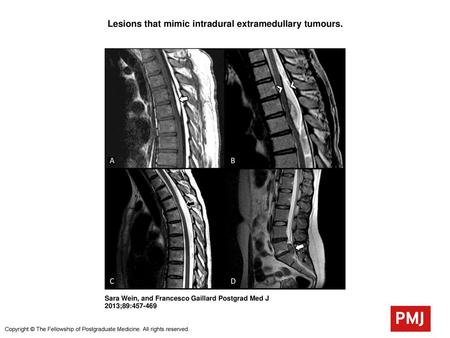 Lesions that mimic intradural extramedullary tumours.