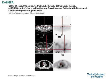 Utility of 99mTc-PEG4-E[PEG4-c(RGDfK)]2 in Posttherapy Surveillance of Patients with Reelevated Carcinoembryonic.