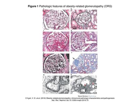 Figure 1 Pathologic features of obesity-related glomerulopathy (ORG)