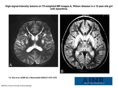 High-signal-intensity lesions on T2-weighted MR images