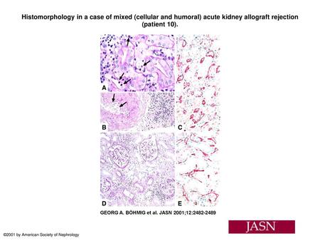 Histomorphology in a case of mixed (cellular and humoral) acute kidney allograft rejection (patient 10). Histomorphology in a case of mixed (cellular and.