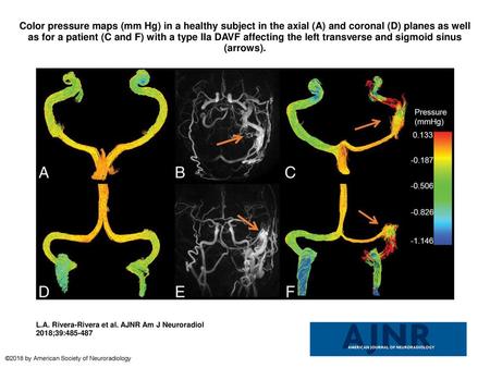 Color pressure maps (mm Hg) in a healthy subject in the axial (A) and coronal (D) planes as well as for a patient (C and F) with a type IIa DAVF affecting.
